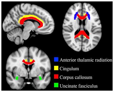 Elevated Aggression and Reduced White Matter Integrity in Mild Traumatic Brain Injury: A DTI Study